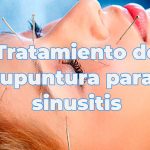 Tratamiento de acupuntura para la sinusitis
