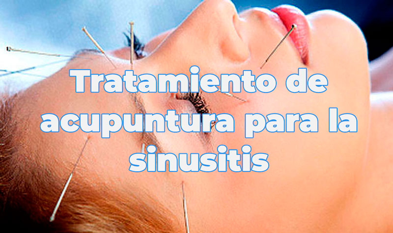 Tratamiento de acupuntura para la sinusitis